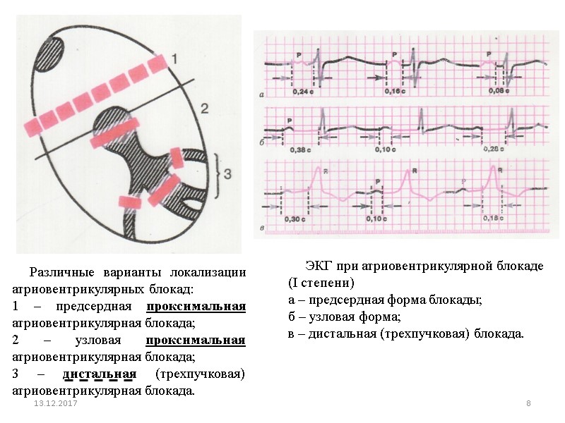 Различные варианты локализации атриовентрикулярных блокад: 1 – предсердная проксимальная атриовентрикулярная блокада; 2 – узловая